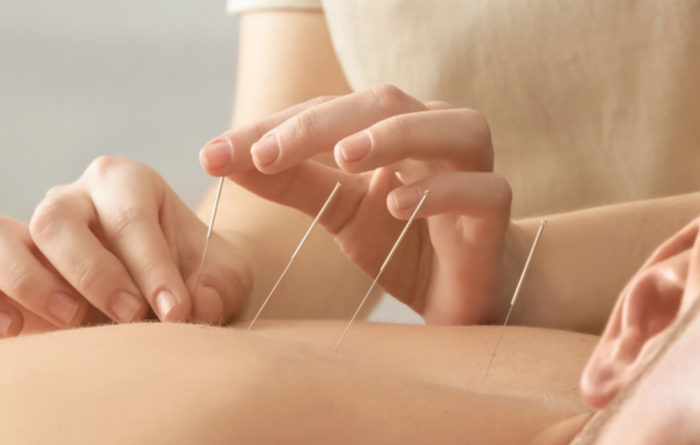 Does dry needling help inflammation?
