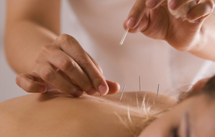 Does dry needling help muscle knots?