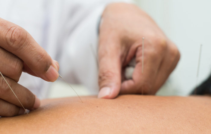 Does dry needling release toxins?