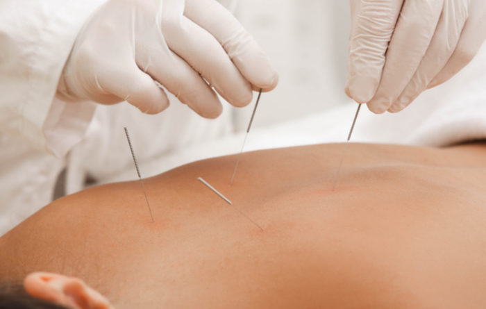 How do you know if dry needling is working?