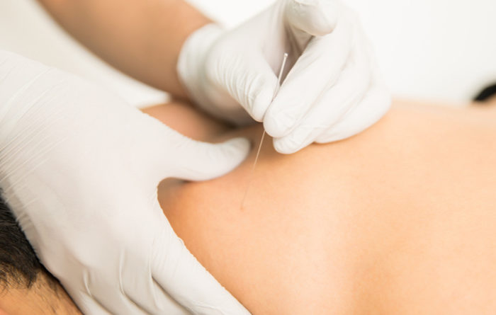 How long does dry needling relief last?