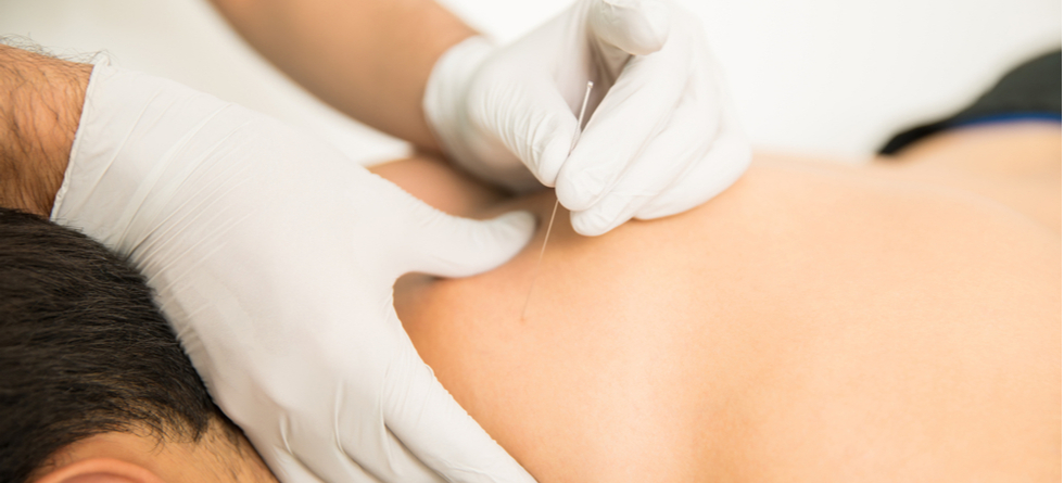 How long does dry needling relief last?
