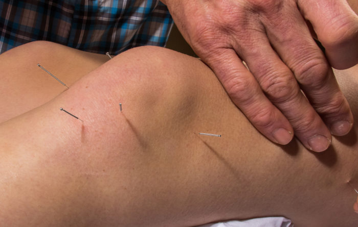 How many sessions of dry needling are needed?