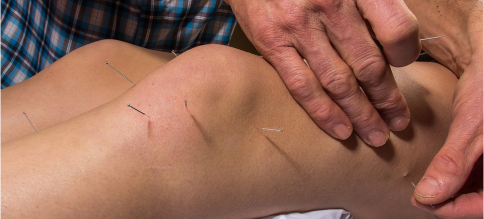 How many sessions of dry needling are needed?