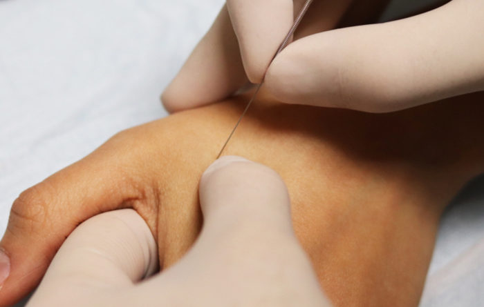 Should you ice or heat after dry needling?