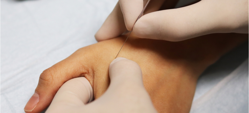 Should you ice or heat after dry needling?