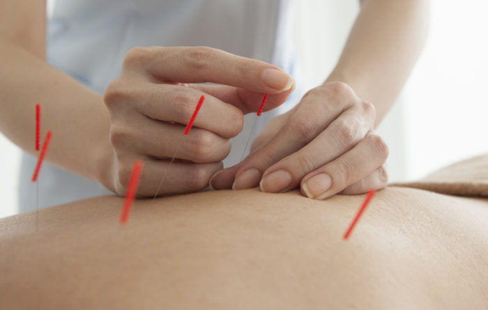 What does dry needling do for you?