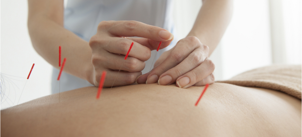 What does dry needling do for you?