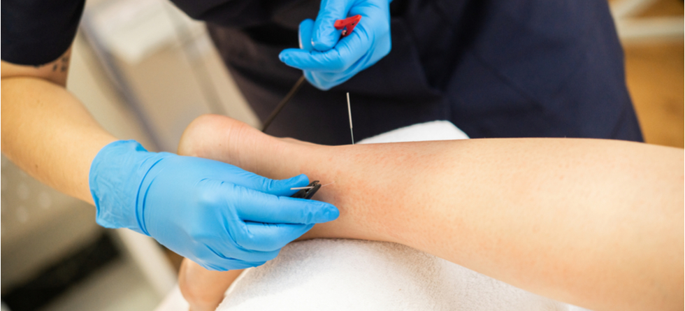 What should you not do after dry needling?