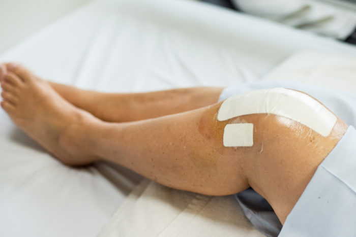 How Common Is Joint Replacement Surgery?