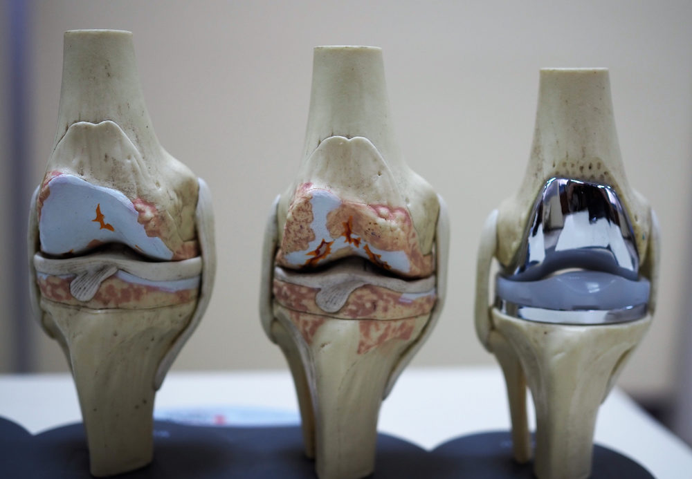 What Is A Total Joint Replacement Called?