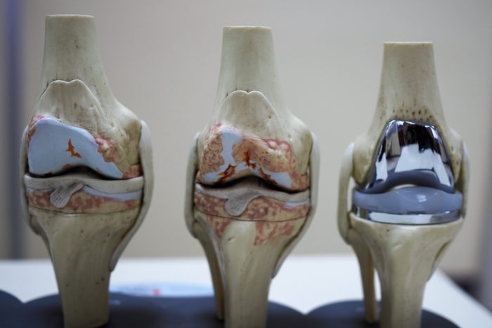 What Is A Total Joint Replacement Called?